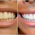 Teeth-Whitening-Strips
