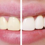 what is the average cost of teeth whitening