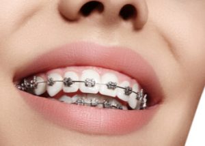 Orthodontics vs cosmetic dentistry